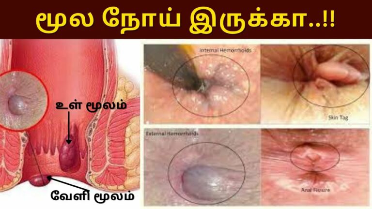 ஆப்ரேஷன் செய்தவர்களுக்கு மீண்டும் பைல்ஸ் பாதிப்பு வருமா? மருத்துவர் சொன்ன உண்மை!!