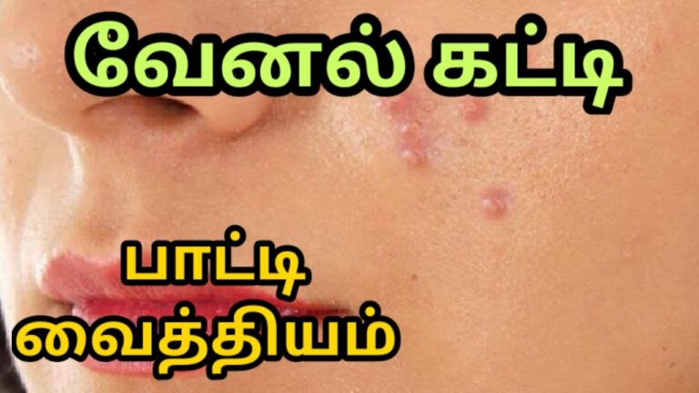 வேனல் கட்டியை வலி இன்றி குணமாக்க.. இந்த 04 வீட்டு வைத்தியங்களை உடனே செய்து பாருங்கள்!!