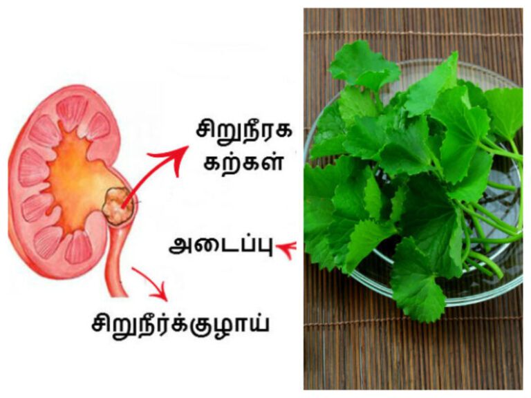கிட்னி ஸ்டோன் பனி போல் கரைய.. இந்த சித்த வைத்தியத்தை ட்ரை பண்ணுங்கள்!!