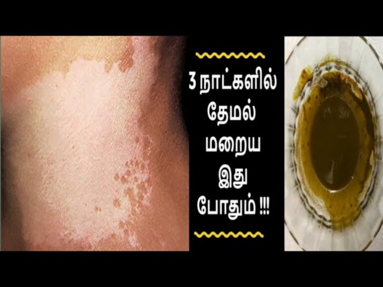 இந்த ஒரு இலை போதும்.. சரும மங்கு தேமல் 7 தினங்களில் மாயமாகிவிடும்!!