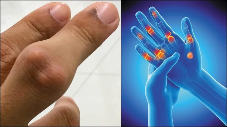 யூரிக் அமிலத்தை குறைக்க ஒரு ஸ்பூன் பார்லி அரிசியை இப்படி யூஸ் பண்ணுங்க!!