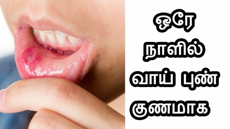 உதட்டு ஓரத்தில் புண்கள் உள்ளதா? ஒரே இரவில் குணமாக இதை மட்டும் செய்யுங்கள்!!