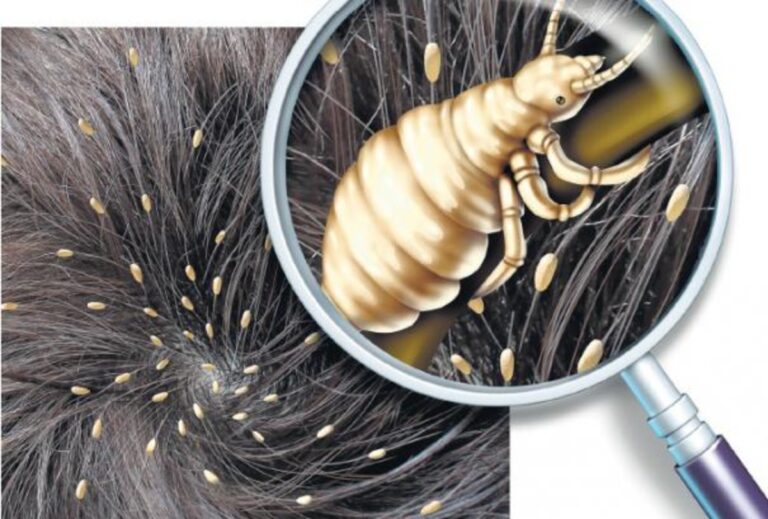 ஒரே பேன் கடியா இருக்கா? இந்த கீரையை அரைத்து தலைக்கு தடவி குளித்தால் ஒரு மணி நேரத்தில் பேன் ஒழியும்!!