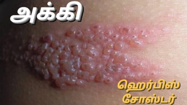 இந்த பூவை அரைத்து அக்கி மீது தேய்த்தால்.. ஒரே நாளில் மாயமாகிவிடும்!!