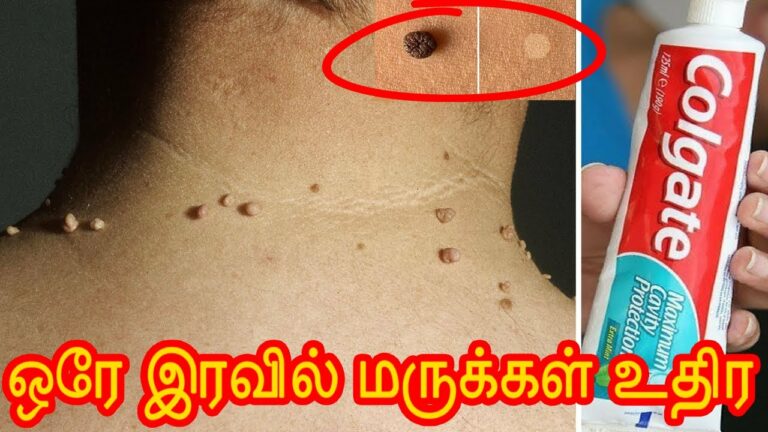 தோலில் தொங்கிய மருக்களை உதிர வைக்க.. இந்த டிப்ஸ் ட்ரை பண்ணுங்க!!