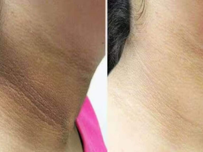 கழுத்து கருமைக்கு அருமையான ஹோம் ரெமிடி!! 100% ரிசல்ட் கிடைக்கும்!!